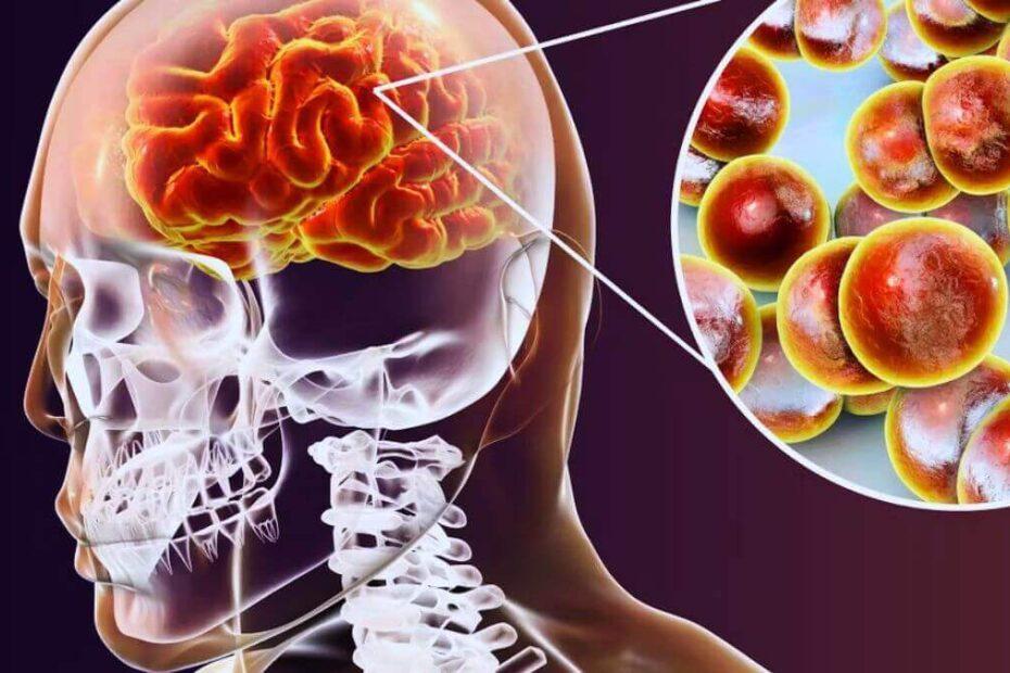 meningitis-quien-la-padece