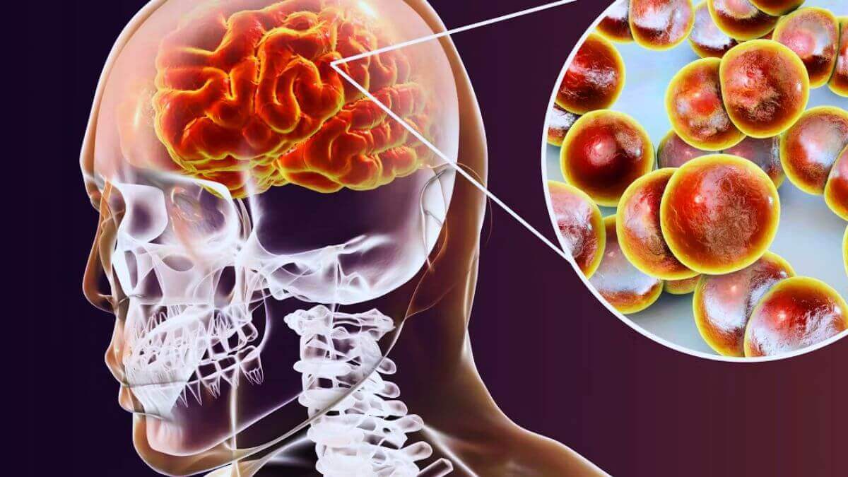 meningitis-quien-la-padece
