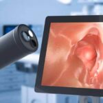 importancia de la colonoscopia