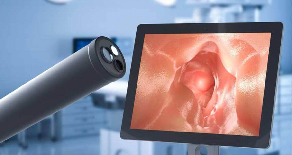 importancia de la colonoscopia